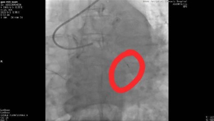 河南一老人做冠脉造影手术时一截导丝断在血管中！院方回应