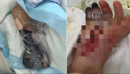 戴手套！戴手套！死亡率近100%，浙江已有人中招