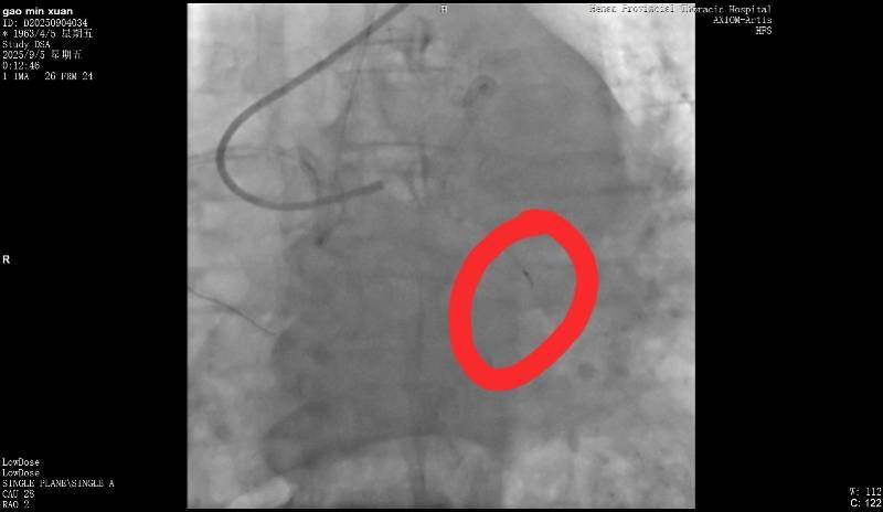 河南一老人做冠脉造影手术时一截导丝断在血管中！院方回应